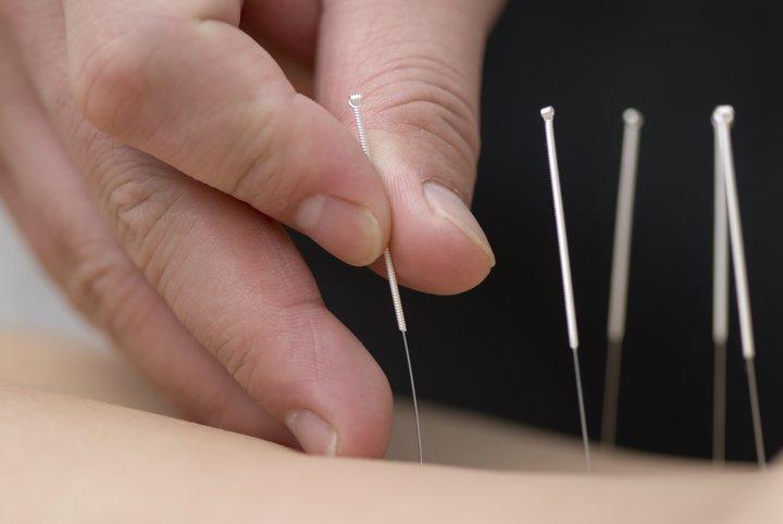 Vivir con artritis reumatoide: los beneficios de la acupuntura
