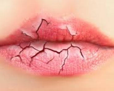 Soluciones caseras para los labios agrietados